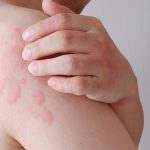 Svrbive vyrazky sa objavia za minuty Chlad moze sposobit aj zivot ohrozujucu reakciu