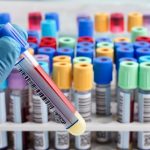 Castesi jej trpia predkovia Keltov no postihuje aj Slovakov Neliecena hemochromatoza moze vest k cirhoze pecene