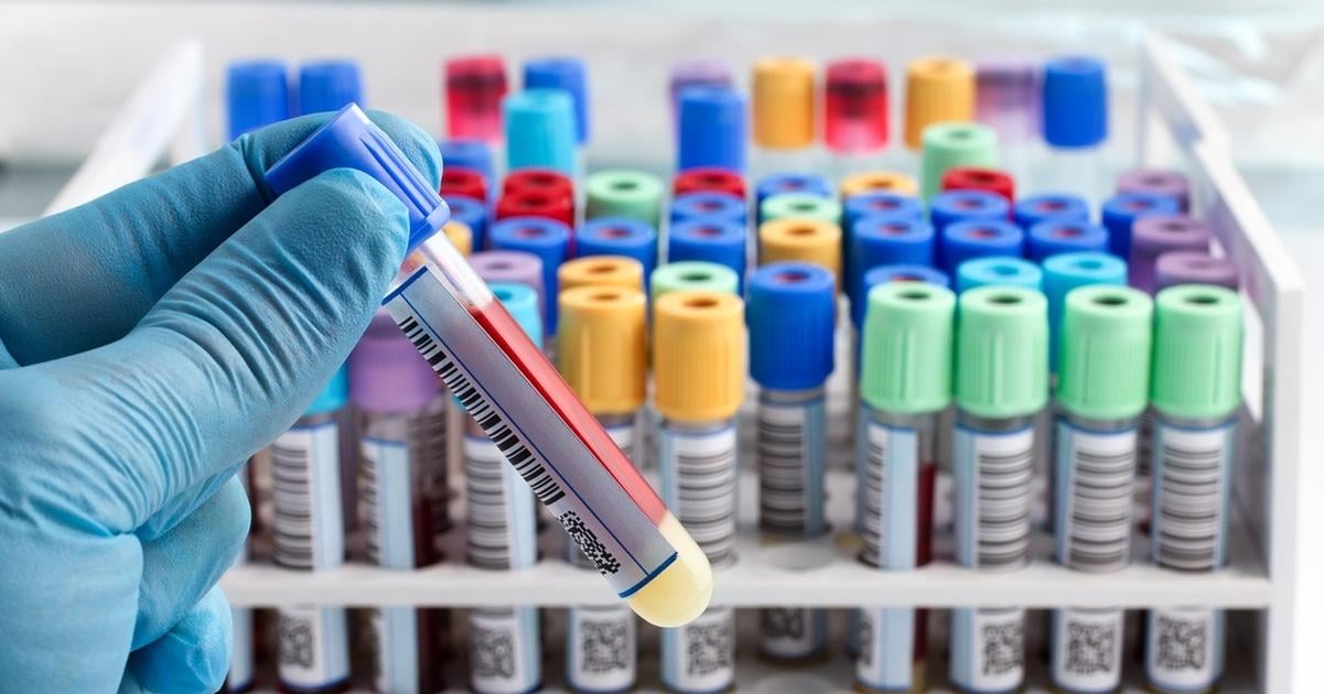 Castesi jej trpia predkovia Keltov no postihuje aj Slovakov Neliecena hemochromatoza moze vest k cirhoze pecene